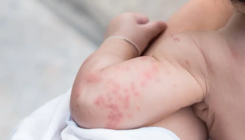 Braccio di un neonato con eritema, macchie rosse e pruriginose sulla pelle.
