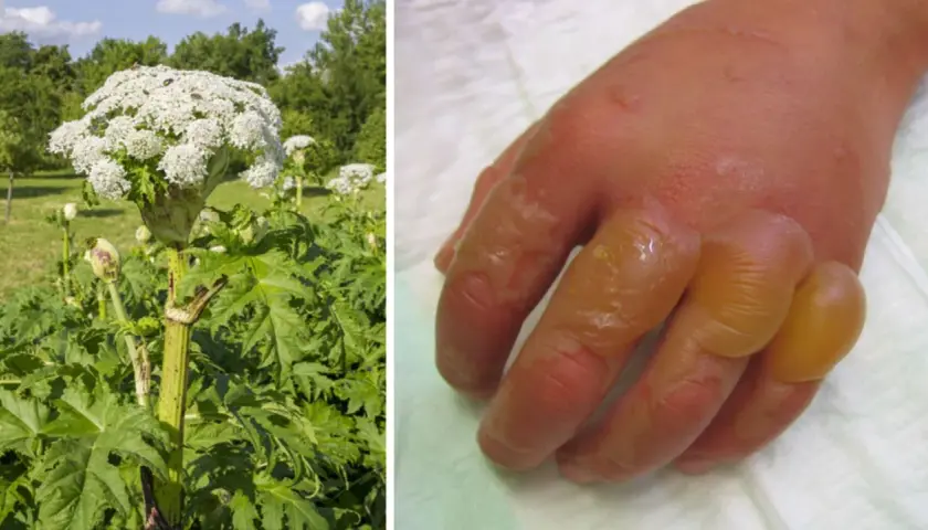 Riesige Herkulesstaude neben einer Hand mit schweren Brandblasen, die durch Kontakt mit der Pflanze entstanden sind.
