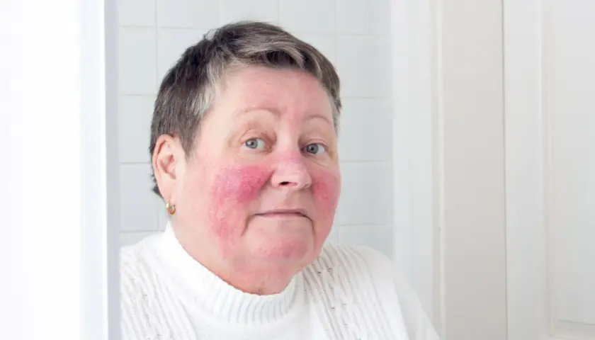 Kvinna med rodnad i ansiktet, troligen rosacea på kroppen.