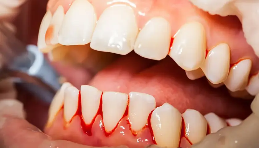 Encias inflamadas con sangrado alrededor de los dientes. Se observa un instrumento dental.