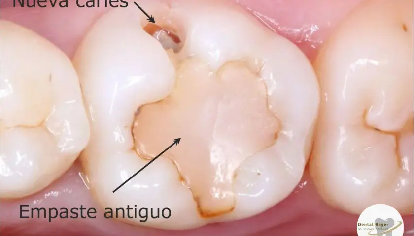 Diente con empaste antiguo y nueva caries. El empaste ha cedido, dejando espacio para la caries.