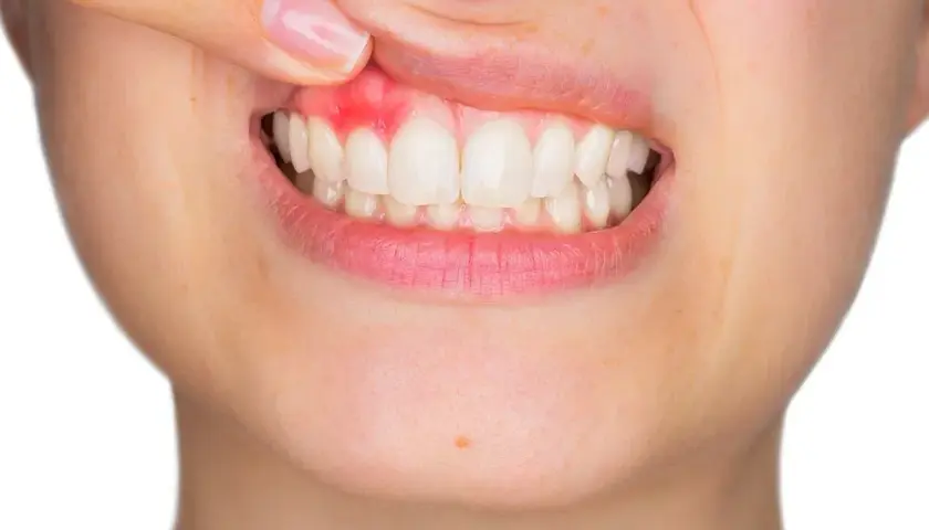 Zapalenie dziąseł u dziecka: Ile trwa i kiedy do dentysty?
