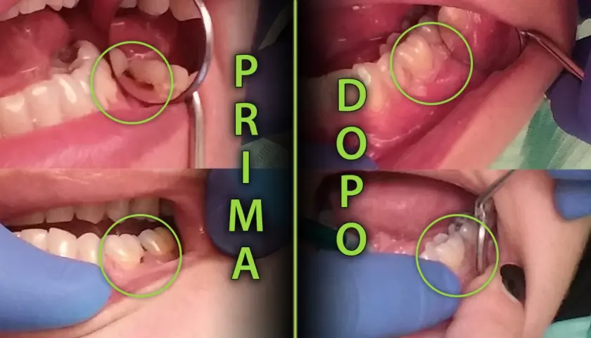 Prima e dopo il trattamento di una carie al colletto dentale. La carie è visibile in verde.