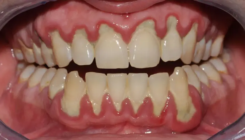 Gengive infiammate e retratte, con accumuli giallastri alla base dei denti, mostrano perché vengono le placche e i problemi che causano.