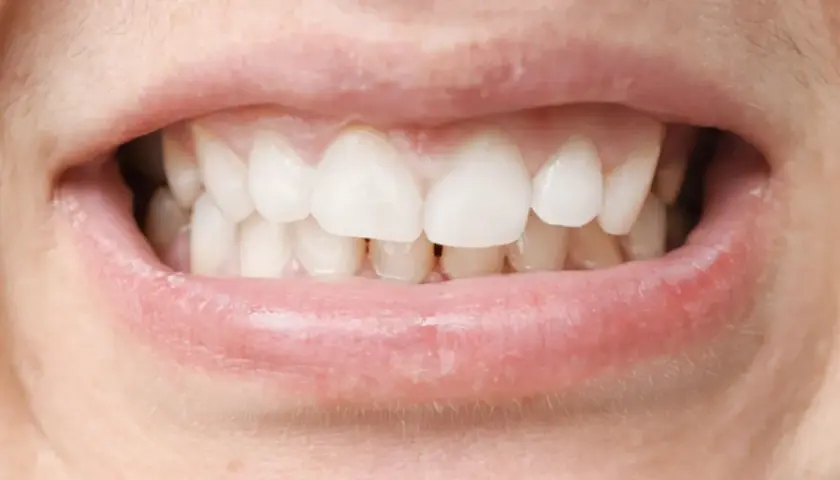 Primer plano de una boca con dientes blancos y labios rosados. Se observa una mordida profunda, donde los dientes superiores cubren significativamente los inferiores.