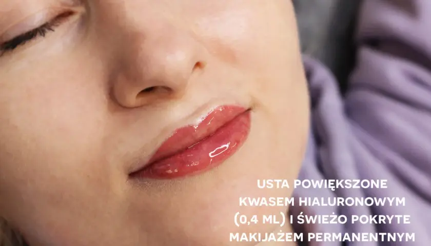Usta po powiększeniu kwasem hialuronowym i wygojony makijaż permanentny ust. Efekt pełnych, lśniących warg.