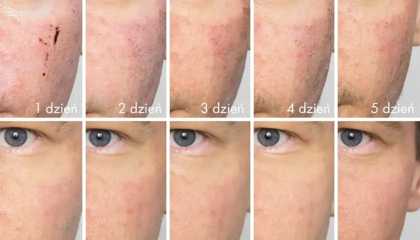 Post-zabiegowa regeneracja skóry po laserze frakcyjnym. Widoczna poprawa od 1 do 10 dnia.