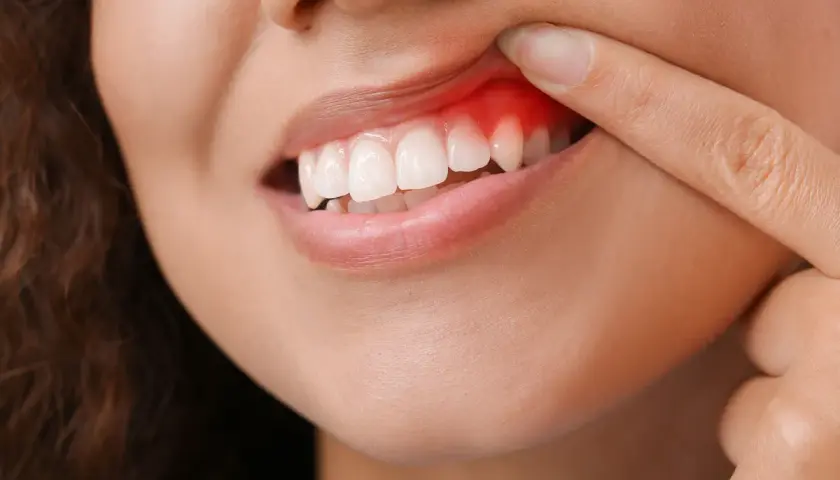 Dito indice indica un'infiammazione gengive, con arrossamento e gonfiore visibili attorno ai denti.