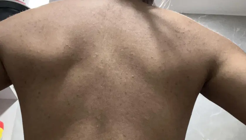 Ryggen visar många små utslag och en stor pormask.