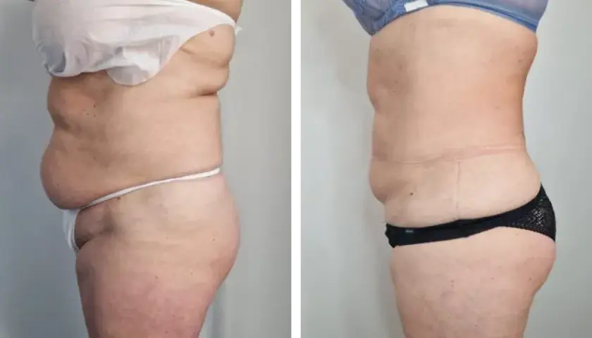 Liposukcja: Co to jest? Pełny przewodnik po zabiegu.