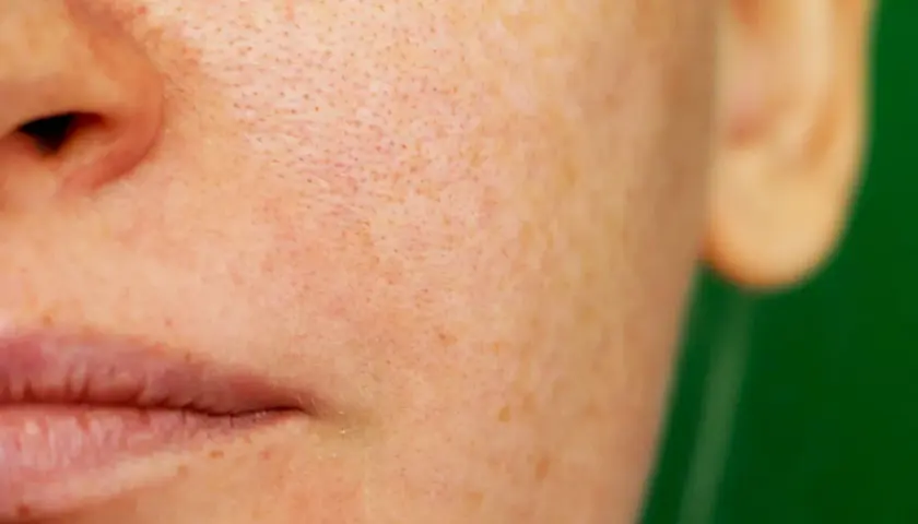 Närbild på en persons ansikte med synliga porer och pigmentfläckar, som visar effekterna av melasma behandling.