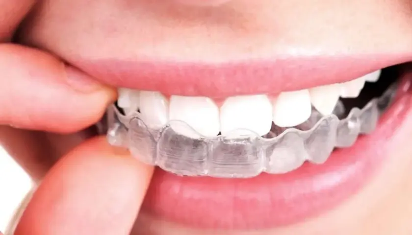 Una persona se ajusta un alineador transparente. Aunque el tratamiento es discreto, a veces el **invisalign duele** al principio.