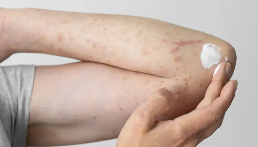 Arm mit roten Flecken und Creme, deutet auf einen **pollenallergie ausschlag** hin.