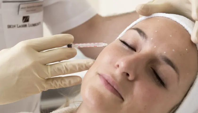 Zabieg z użyciem botoksu: precyzyjne botox miejsca wstrzyknięć na czole i skroniach.