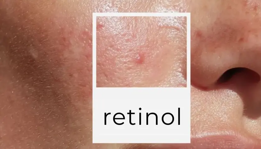 Zbliżenie na skórę z niedoskonałościami, w tym pryszczami i bliznami potrądzikowymi. W ramce napis "retinol", sugerujący pytanie: retinol od jakiego wieku można stosować.