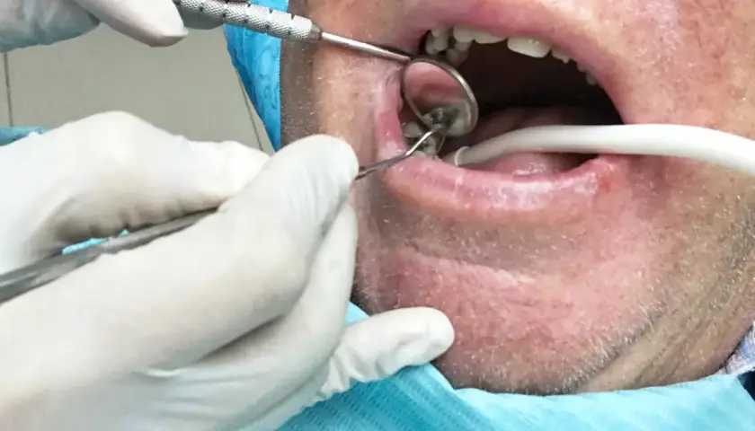Dentysta usuwa korzeń zęba z ropą. Widać narzędzia stomatologiczne i usta pacjenta.