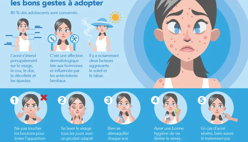 Illustration sur l'acné des adolescents. Cinq étapes pour gérer les boutons de puberté : ne pas toucher, laver, démaquiller, hygiène de vie, consulter un dermatologue.