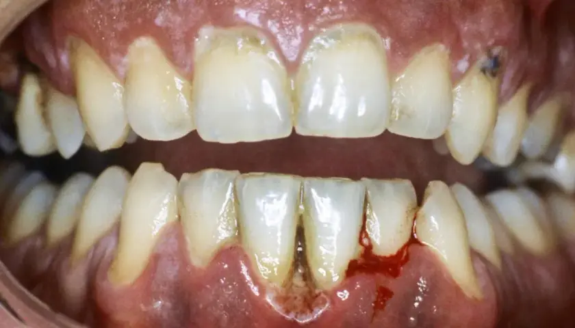 Gengive infiammate e sanguinanti, denti ingialliti e con tartaro, un quadro di dolore alle gengive e denti che necessita cure.