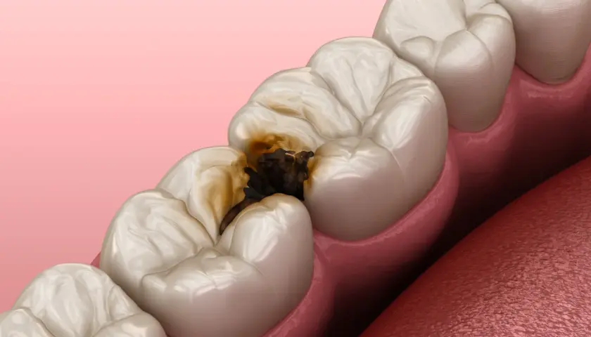 Dente cariato con cavità scura che raggiunge la polpa dentale.