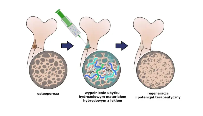 Schemat leczenia osteoporozy: wstrzyknięcie hydrożelu z lekiem do ubytku kostnego, co prowadzi do regeneracji i potencjału terapeutycznego.