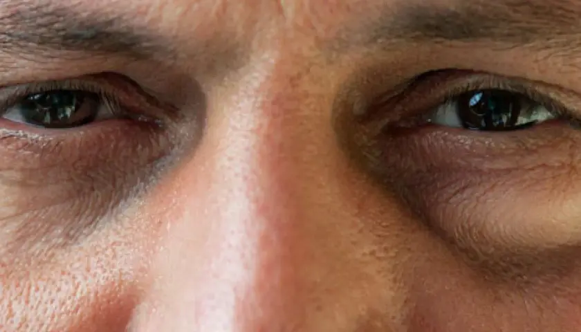 Nahaufnahme eines Gesichts mit einem leicht geschwollenen Auge. Was tun bei einem Auge angeschwollen? Hier sind Tipps.
