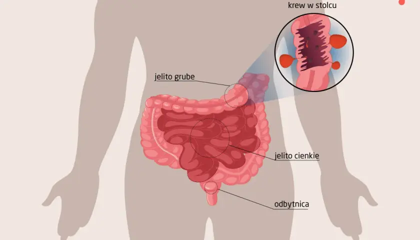 Ilustracja przedstawia jelito grube, cienkie i odbytnicę. Powiększony fragment pokazuje krew w stolcu, co może świadczyć o problemach zdrowotnych.