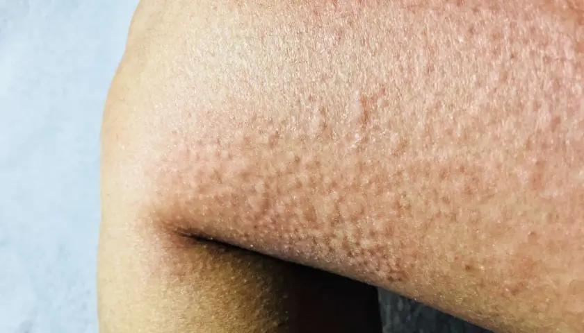 Pelle arrossata con piccoli pomfi, tipica dell'orticaria. Scopri come curarla.
