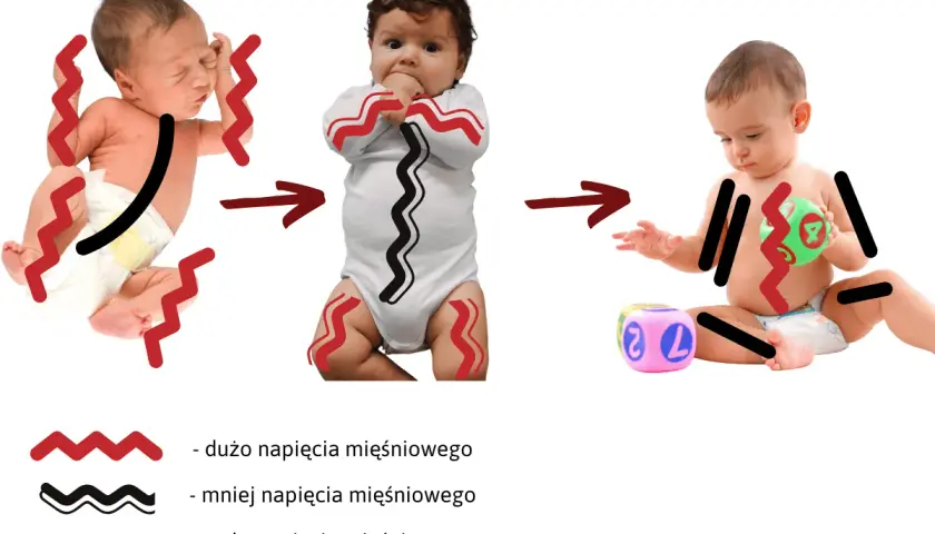 Zmiana napięcia mięśniowego u niemowląt: od dużego napięcia do hipotonia mięśniowa.