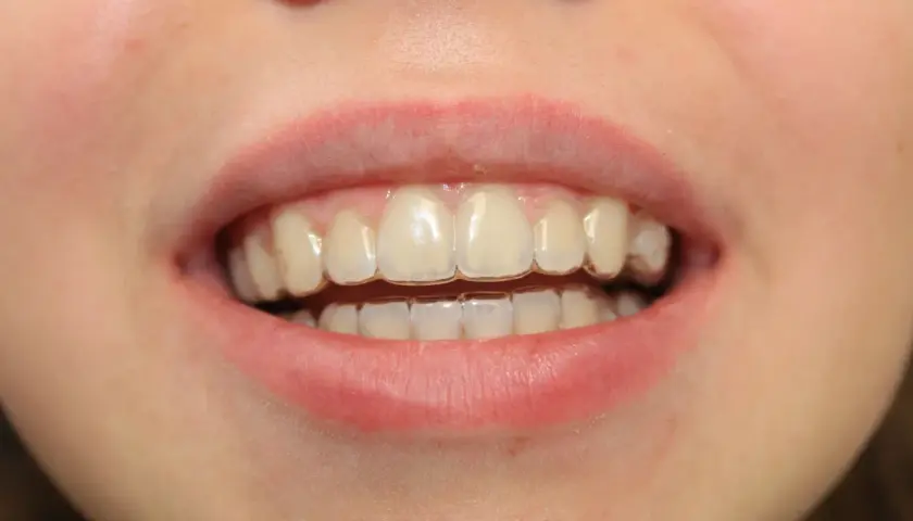 Uśmiech z aparatem Invisalign. Widoczne przezroczyste nakładki na zębach, które korygują zgryz. Efekty leczenia są już widoczne.