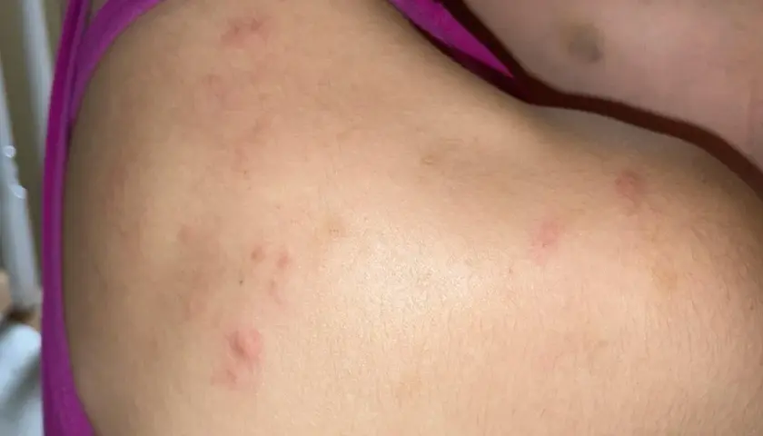 Piel con marcas rojas y elevadas, indicando posible acne en la espalda.