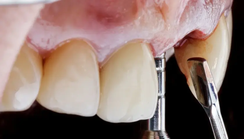 Dettaglio di un impianto dentale provvisorio in fase di posizionamento, con strumenti dentistici e denti in primo piano.