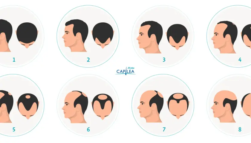 Escala de Norwood que muestra la progresión de la pérdida de cabello, desde una densidad capilar completa hasta la calvicie.