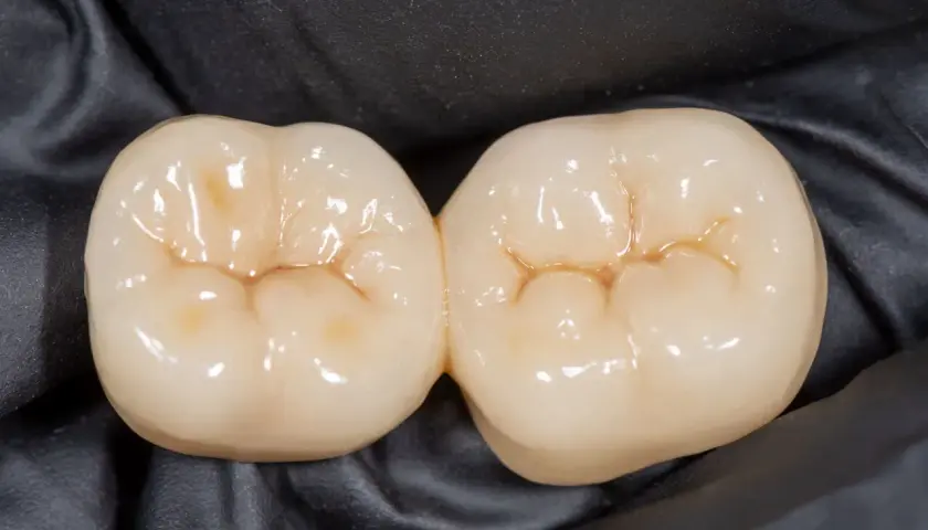 Dwa połączone zęby ceramiczne z widocznymi bruzdami na zębach, gotowe do odbudowy uśmiechu.