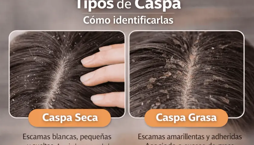 Dos tipos de caspa: seca (escamas blancas, sueltas) y grasa (amarillentas, adheridas). Aprende cómo quitar la caspa identificando la tuya.