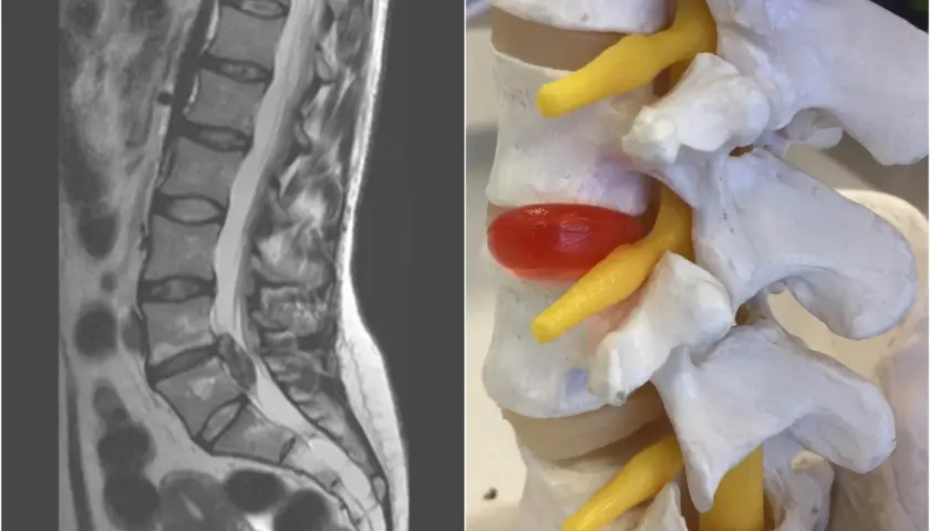 Obraz porównuje rezonans magnetyczny kręgosłupa z modelem anatomicznym, ukazując bulging krążka międzykręgowego uciskającego nerw.
