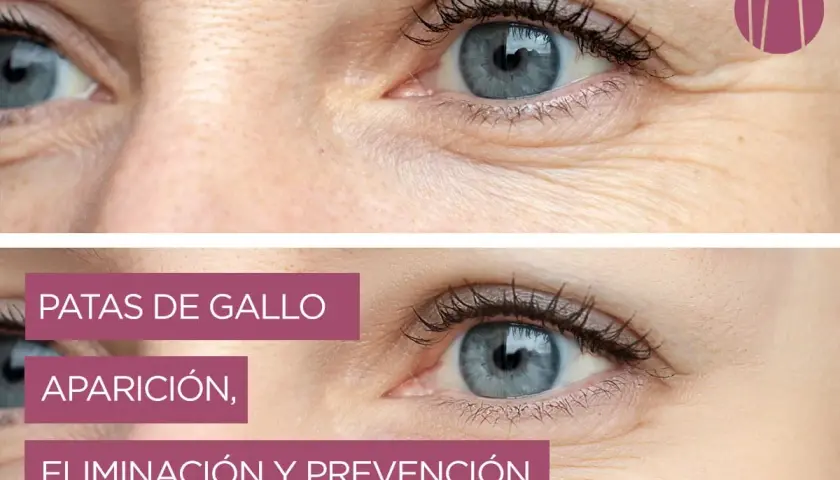Ojos con y sin **patas de gallo**. La imagen superior muestra arrugas marcadas, mientras que la inferior, con piel más lisa, ilustra la eliminación y prevención.