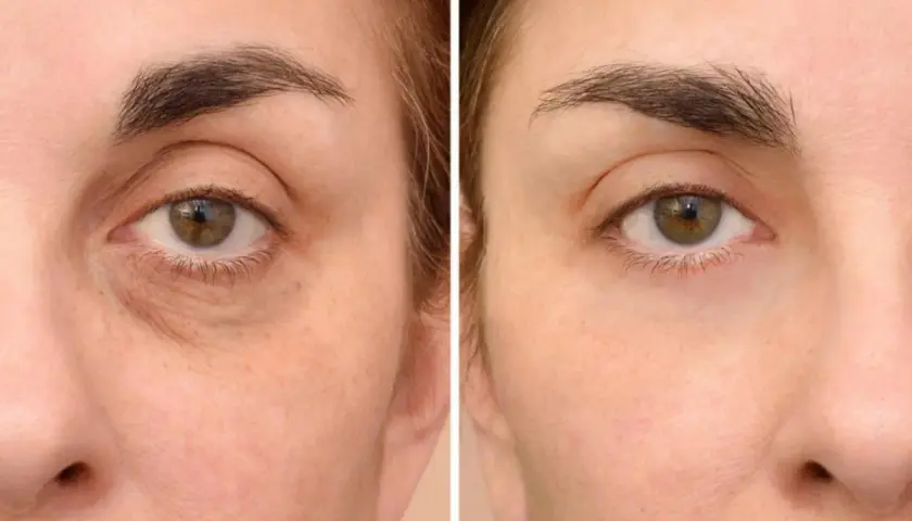 Antes y después de un tratamiento para quitar ojeras oscuras. La piel luce más luminosa y descansada.