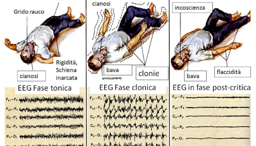 Illustrazione delle fasi di una crisi epilettica tonico-clonica: rigidità, cianosi, incontinenza, bava, clonie, incoscienza. Sintomi premonitori e EEG.