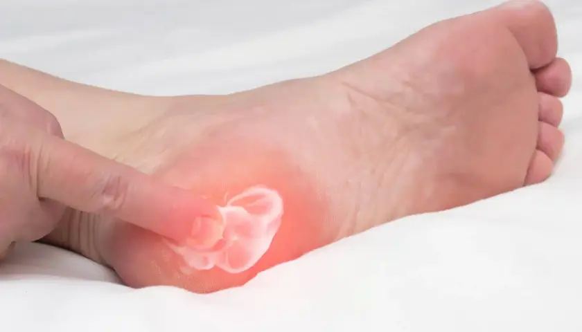 Application d'une crème pour soulager la douleur d'une aponévrosite plantaire. Un doigt masse la zone rouge sur le talon.