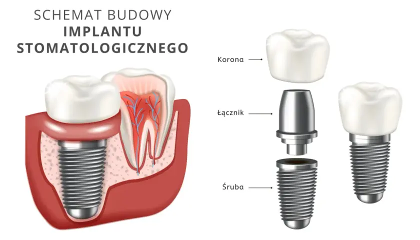 Schemat budowy implantu stomatologicznego: śruba, łącznik i korona. Dowiedz się, ile kosztuje implant zęba 6.