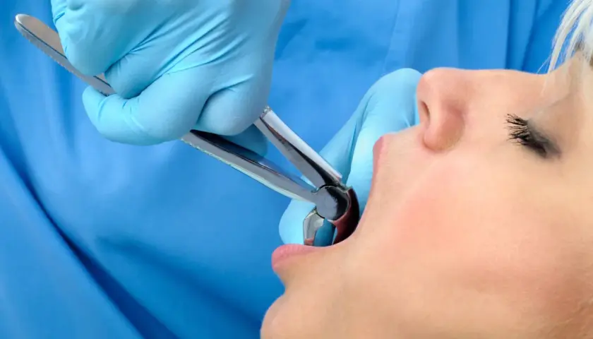 Dentysta w niebieskich rękawiczkach używa kleszczy do ekstrakcji zęba, pozostawiając dziwny posmak po wyrwaniu zęba.