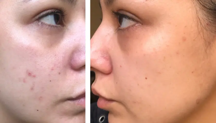 Split image showing a woman's cheek before and after treatment, with reduced redness and blemishes.