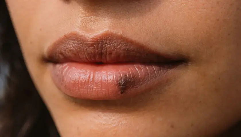 Primer plano de unos labios con una mancha oscura en el labio inferior.