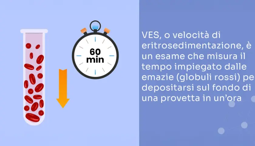 Provetta con globuli rossi e cronometro indicano un esame VES, utile per rilevare un'infezione ai denti o altre infiammazioni.