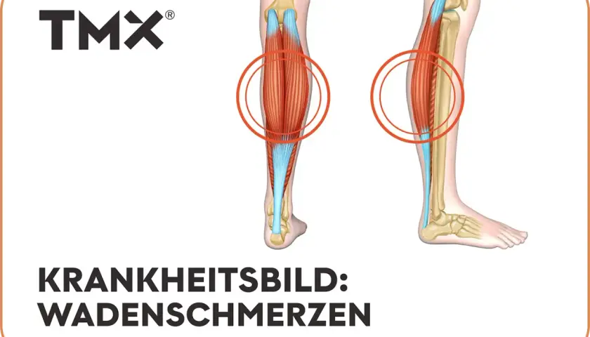 Anatomische Darstellung der Beinmuskulatur mit Hervorhebung der Wadenmuskeln. Rote Kreise markieren Bereiche, die auf **Schmerzen in der Wade** hinweisen könnten.