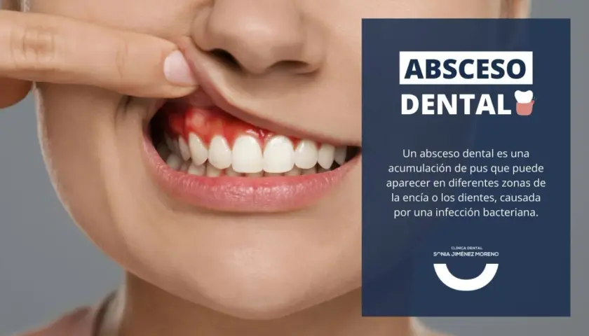 Primer plano de una boca mostrando encías rojas e inflamadas, indicativo de un absceso en la encía. Texto informativo sobre abscesos dentales.