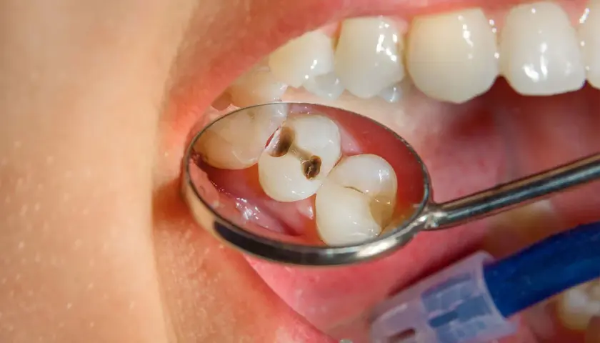 Primo piano di un dente bucato, visibile in uno specchietto dentale. La carie ha creato una cavità scura.