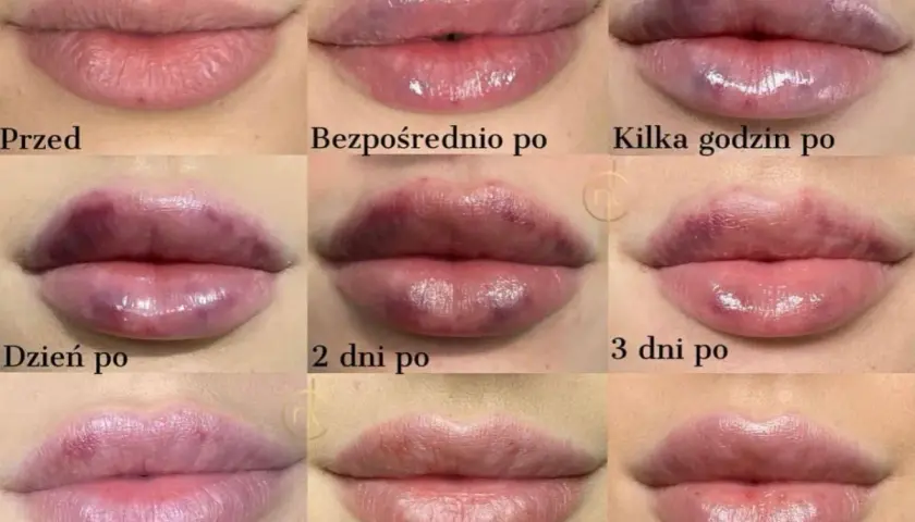 Powiększanie ust: Jaki kwas hialuronowy wybrać? Ekspert radzi