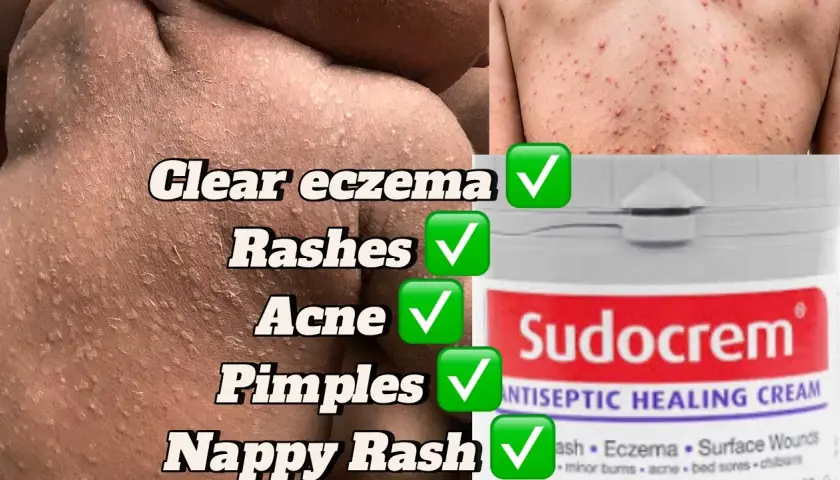 Sudocrem na pryszcze: Czy krem dla dzieci ratuje cerę trądzikową?