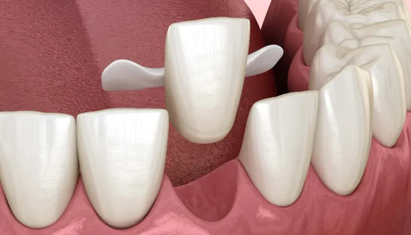 Una corona dentale bianca si posiziona su un dente preparato, pronta a proteggere un dente che si stacca.